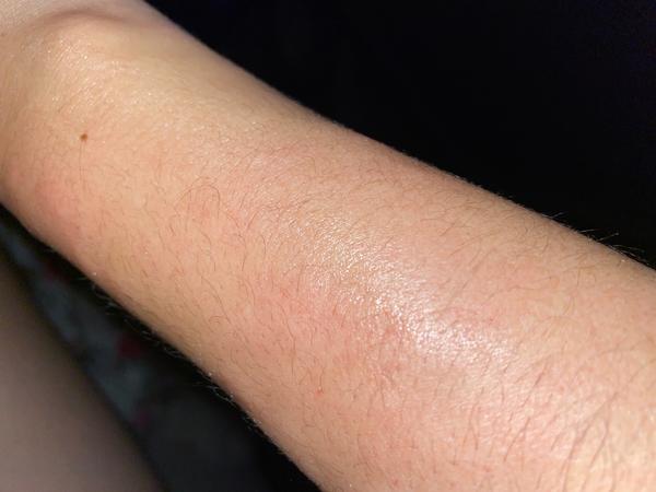 Každú noc ma niečo štípe