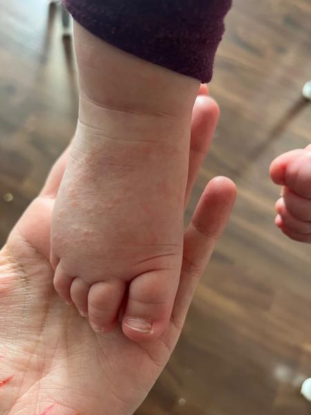 Je vyrážka u 15-mesačného dieťaťa alergia alebo ekzém?