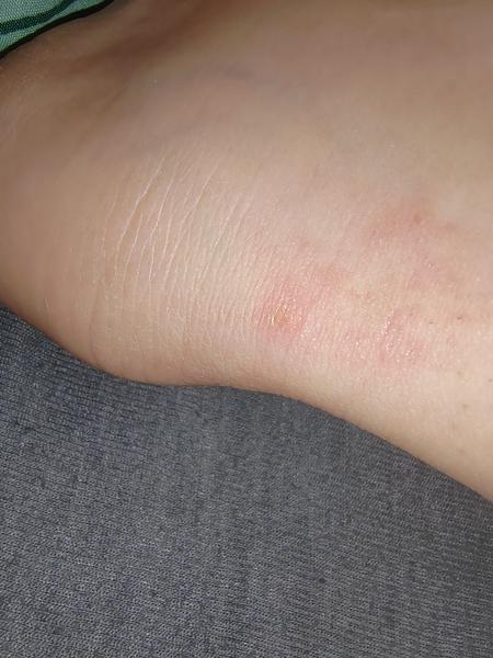 Sú to štípance od ploštice?