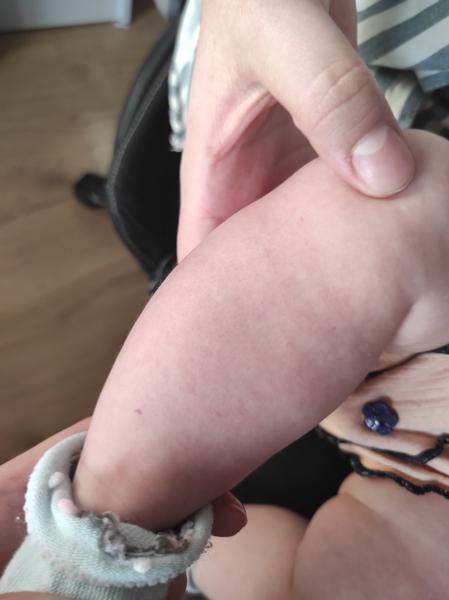 Petéchie u štvormesačného bábätka