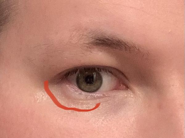 Opuchnuté bolestivé spodné viečko