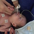 from survivor to warrior my gastroschis