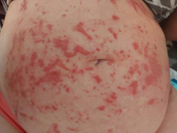 Ako pomôcť matke, ktorá má reakciu na pašternák?