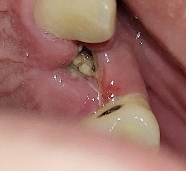 Je normálne mať bolesť 2 dni po extrakcii?