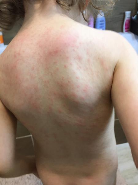 Dlhodobé vyrážky po chorobe u dieťaťa