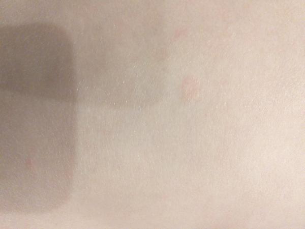 Fľaky u štvorročnej dcéry