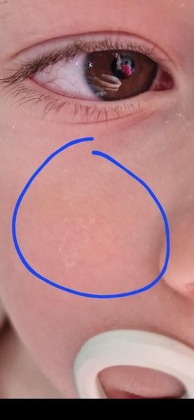 Prečo dieťaťu ostávajú biele škvrny po slzách?