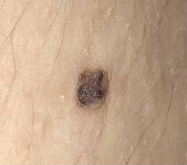 Čierna chrasta na znamienku. O aký problém ide?