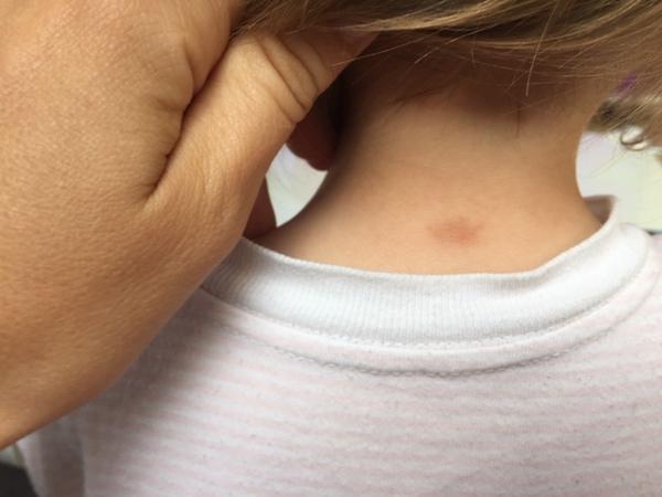 Pribúdajúce pigmentové fliačky u 1,5 ročnej dcérky. O aký problém ide?