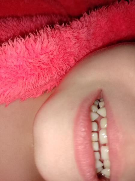 Treba riešiť zubný kameň na predných zuboch?