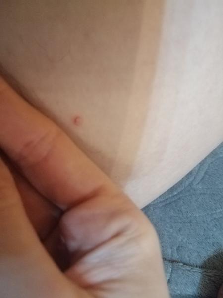 Chcem sa spýtať, netušíte, čo je toto za výražku na vnútorných stehnách?