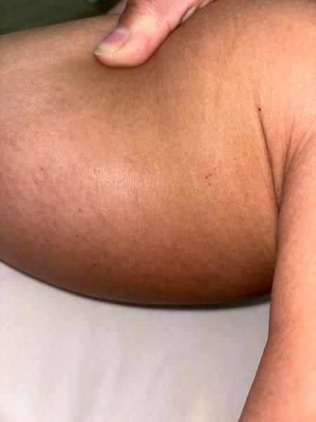 Petéchie pod kolenami: Prečo sa objavujú?