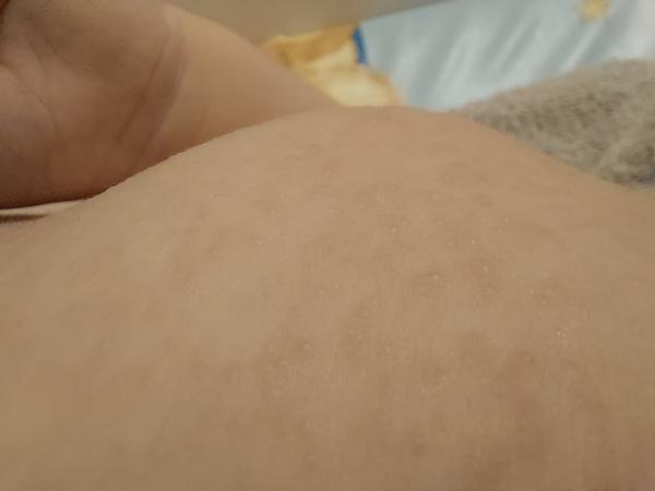 Čo je to za vyrážku?