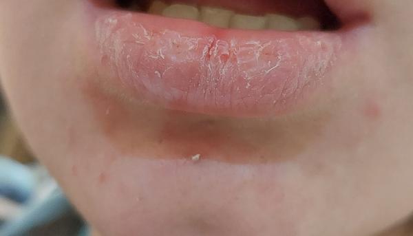 Môžem byť dehydrovaná?