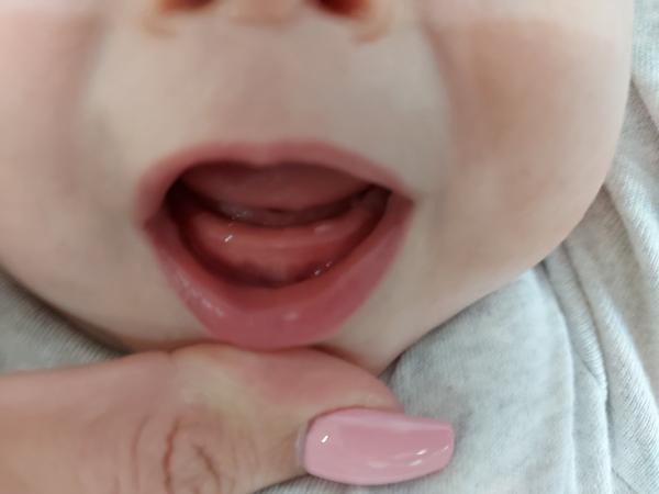 Budú ostatné zúbky krivé?