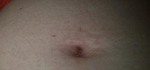 Škvrny na pupku v 22. týždni