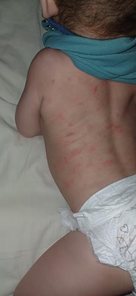 Má môj syn pityriasis rosea? Skúsenosti ostatných vítané