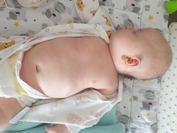 Atopický ekzém u trojmesačného