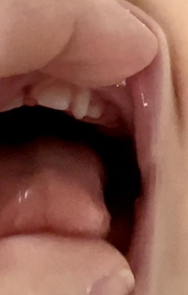 Je šanca, že sa zle vyrastený mliečny zub ešte pootočí?