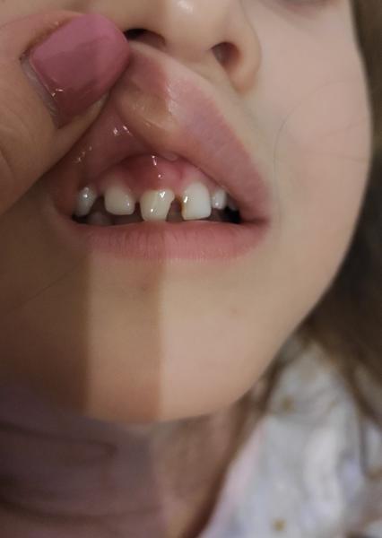 Aký opuch na ďasne má moja dcérka?