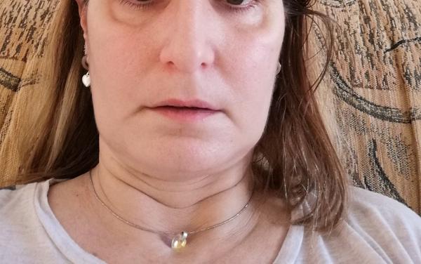 Sú moje opuchy na lícnych kostiach v poriadku?