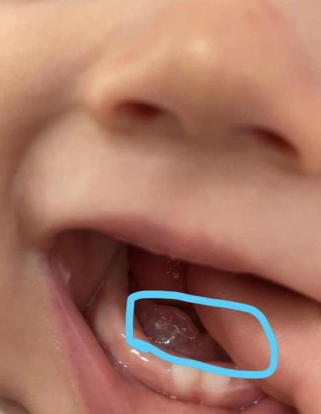 U 8 mesačného bábätka pod jazykom