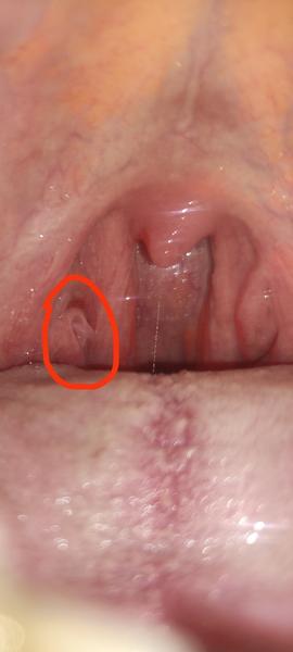 Biely útvar na mandli. Mám navštíviť lekára?