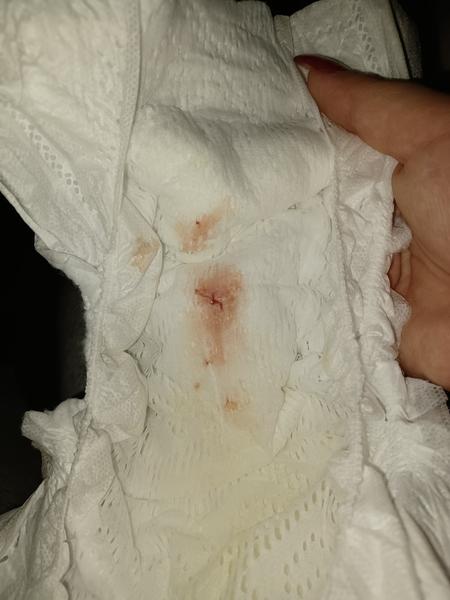 Z akého dôvodu má moje dieťa krv v plienke?