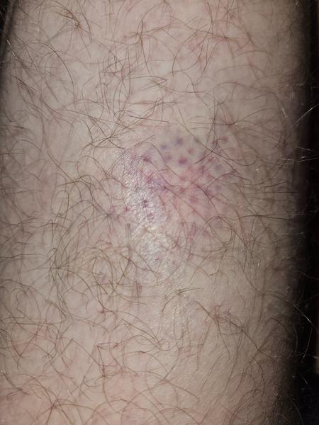 Modrina na nohe bez zjavnej príčiny