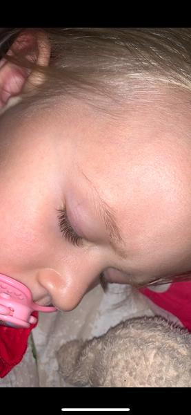 Aké vyrážky má moja dvojročná dcérka?