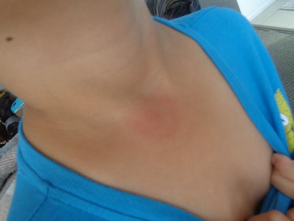 Môže červená vyrážka znamenať boreliózu?