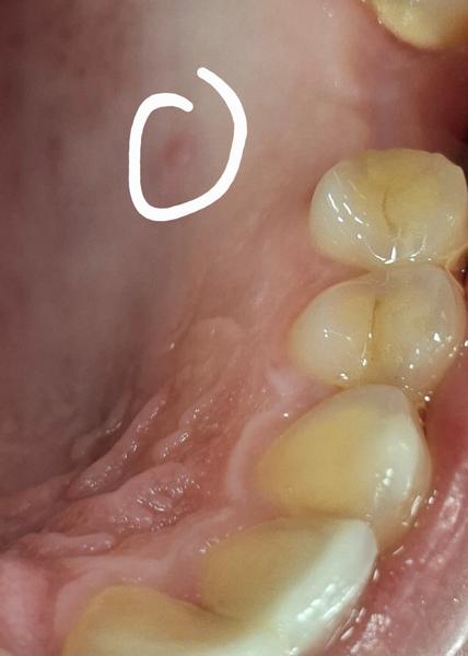 Malá hrčka na podnebí