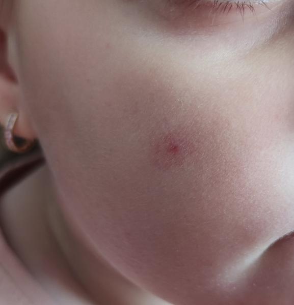 Čo môže znamenať fľak na líci dieťaťa?