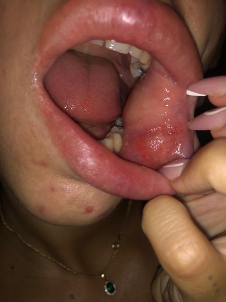 Mám na lícach afty?