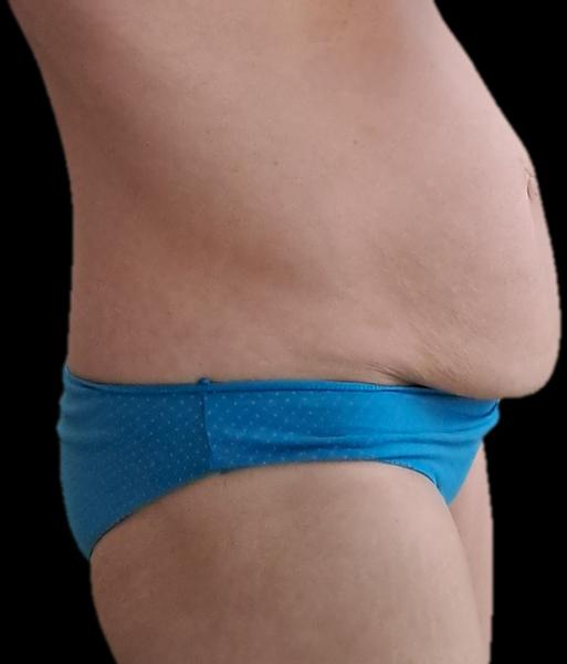 Ako riešiť previs brucha?