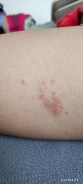 Má moja 5-ročná dcéra svrab?