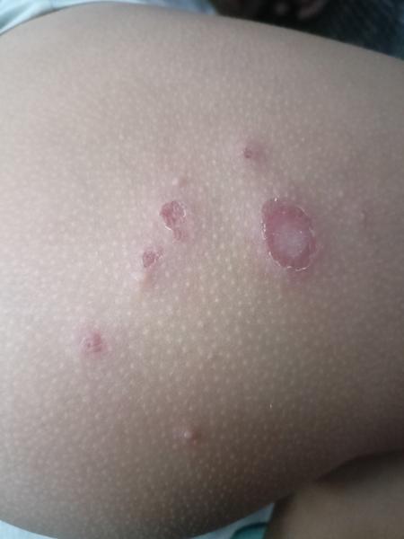 Aký kožný problém má moje dieťa?