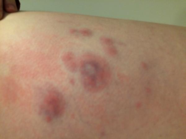 Svrbiace, vypuklé červené fľaky po stehnách