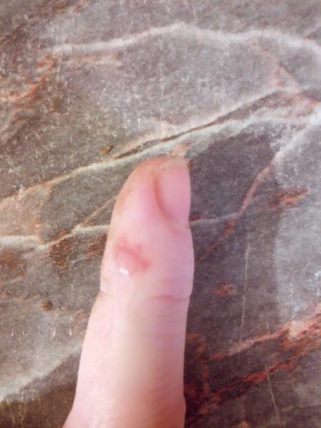 Z čoho mám vyrážky?