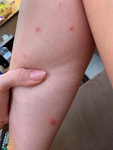 Aké sú to vyrážky?