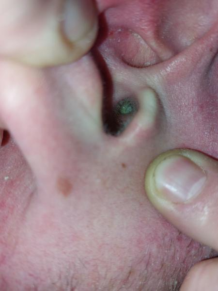 Môže to byť ušná mazová zátka?