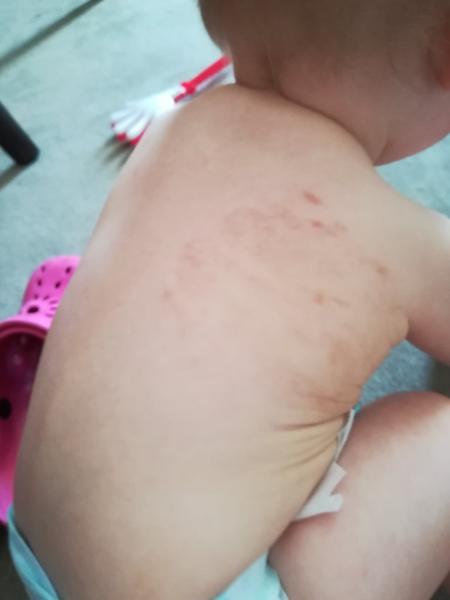 Čo to môže byť? Červené miesta na chrbátiku