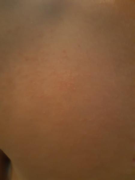 Kožné problémy u syna