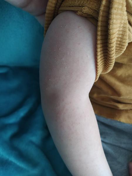 Ako zmierniť vyrážky u 2,5 ročného syna?