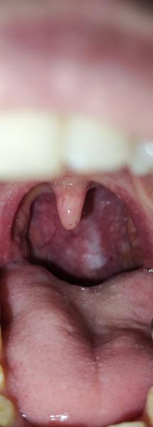 Biele fľaky v hrdle: Čo znamenajú?