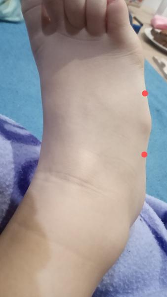 Kostné výrastky u detí