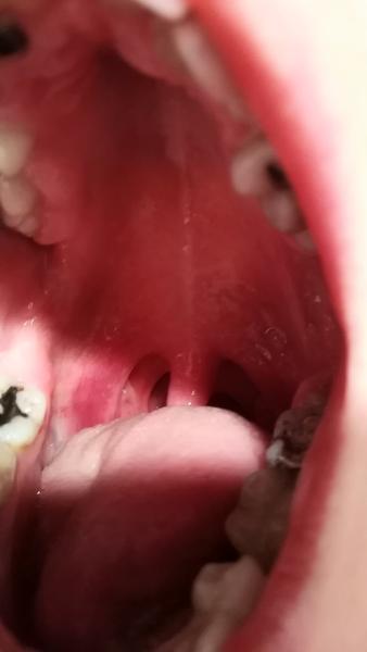 Prečo mám červený hltan na oboch stranách?