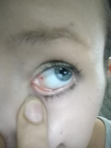 Červená bodka v oku. Čo to môže byť?