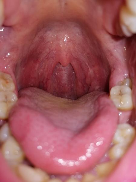 Aké červené nebolestivé výrastky mám na sliznici hrdla?