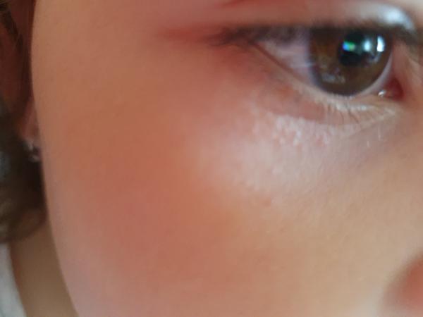 Aké vyrážky to má dcérka pod jedným okom?